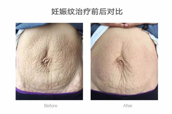 碧無痕妊娠修復(fù)加盟