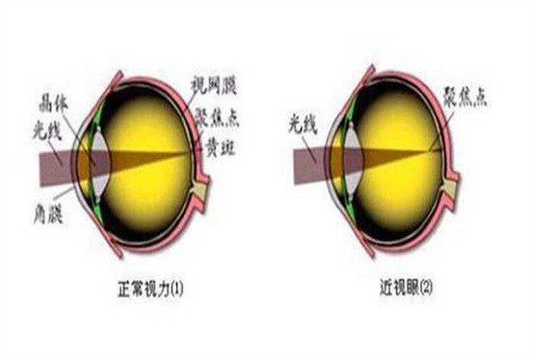 東盛堂近視恢復