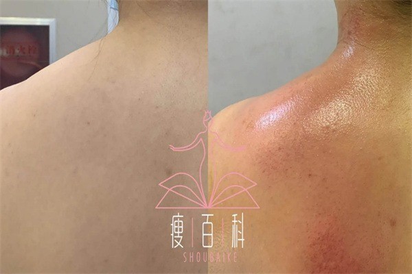 瘦百科減肥加盟